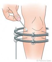 Fixation Pin Care