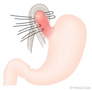 Surgical Correction of GERD