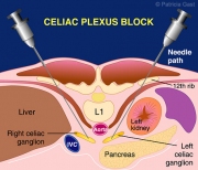 Celiac Plexus Block